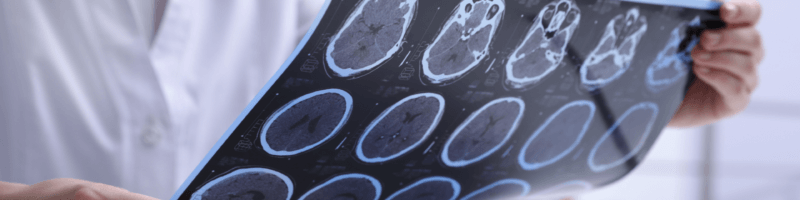 What Is CTE and How Can It Be Diagnosed?