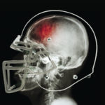 NCAA Concussion Lawsuits